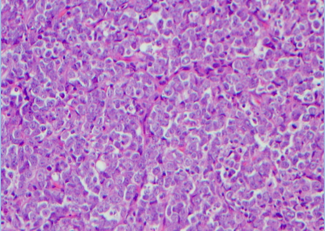 Low power view of paraspinal mass biopsy.  Sections show lymphoblast infiltration that are intermediate in size with fine chromatin, irregular nuclear contours, and scant cytoplasm.  Numerous tingible body macrophages are seen.